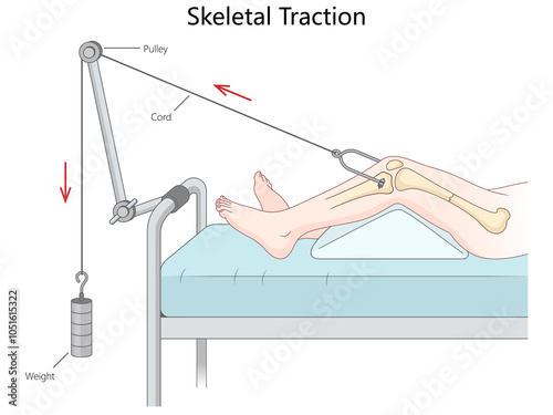 skeletal traction using weights and pulleys to align a leg fracture, showing the mechanism components and setup hand drawn schematic raster illustration. Medical science educational illustration