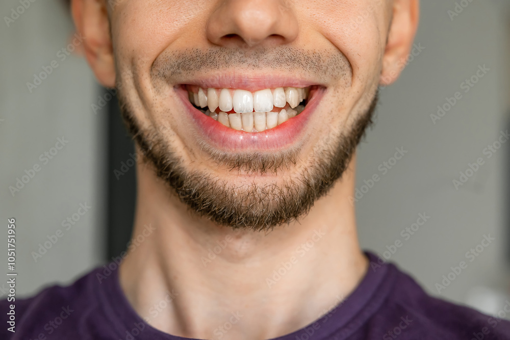 Close-up of smiling man with crooked teeth needing orthodontic treatment Close-up of smiling man with crooked teeth needing orthodontic treatment