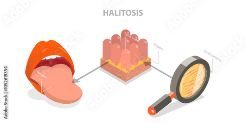 3D Isometric Flat  Illustration of Halitosis, Bacterial Causes of Bad Breath photo