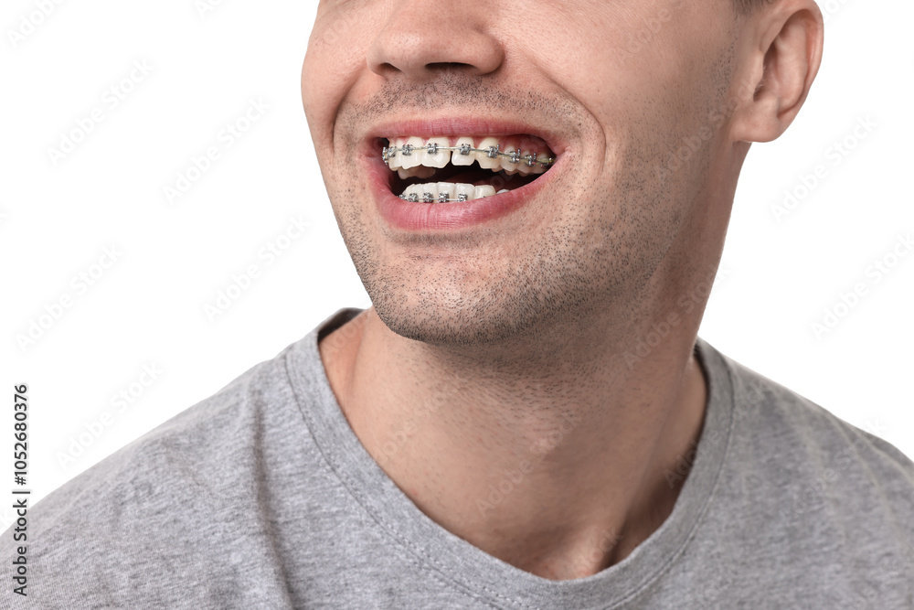 Happy man with dental braces on white background, closeup Happy man with dental braces on white background, closeup