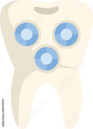 Illustration showing a tooth being filled using modern composite materials