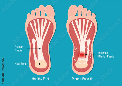 Plantar fasciitis is one of the most common orthopedic.