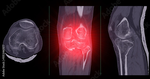 CT Imaging of Tibia and Fibula Fracture in Trauma Case .A detailed CT scan highlighting a traumatic fracture in the tibia and fibula, displaying bone displacement and damage. photo