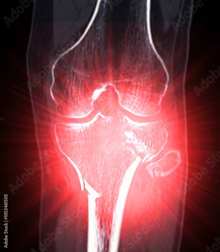 CT Imaging of Tibia and Fibula Fracture in Trauma Case .A detailed CT scan highlighting a traumatic fracture in the tibia and fibula, displaying bone displacement and damage. photo