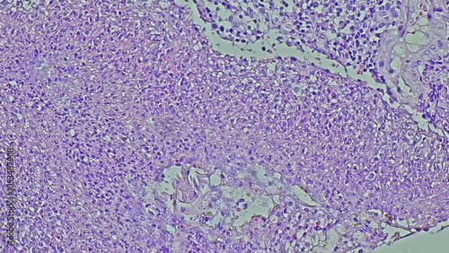 Photomicrograph of pyogenic granuloma, in rectal tumor under microscope in anatomical pathology laboratory