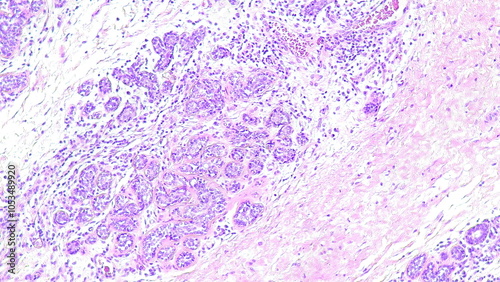 Human cervical cell tissue under a microscope in a pathology laboratory. Microscopic view of fibrosing mammary adenosis, hematoxylin eosin staining