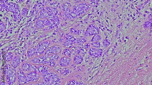 Human cervical cell tissue under a microscope in a pathology laboratory. Microscopic view of fibrosing mammary adenosis, hematoxylin eosin staining photo