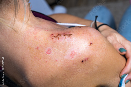 Girl after surgery for broken shoulder. Close up of surgical incision on right shoulder joint, medical sutures