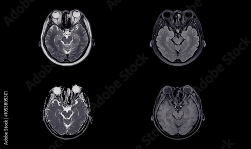 A normal contrast-enhanced MRI scan of the brain showing clear ventricles and surrounding brain tissue, with no abnormalities detected, indicating normal neurological health. photo
