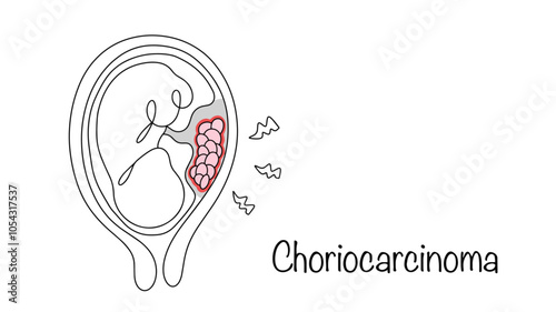 Choriocarcinoma