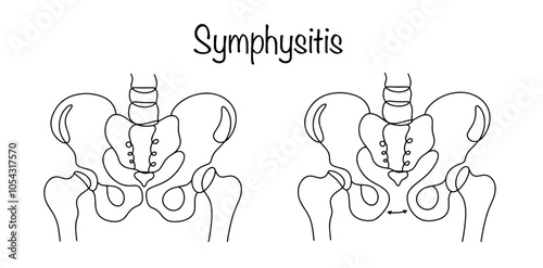 Symphysitis