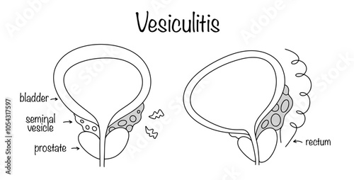 Vesiculitis