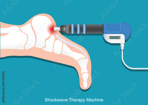 ESWT or Extracorporeal shock wave therapy.