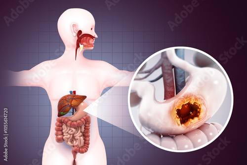 Stomach or gastric cancer with organs and tumors. 3d illustration photo