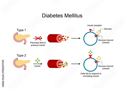 Diabetes mellitus type 1, pancreas's failure to produce enough insulin and type 2, cells fail to respond to insulin (Insulin resistance). High blood glucose levels. Diagram illustration.