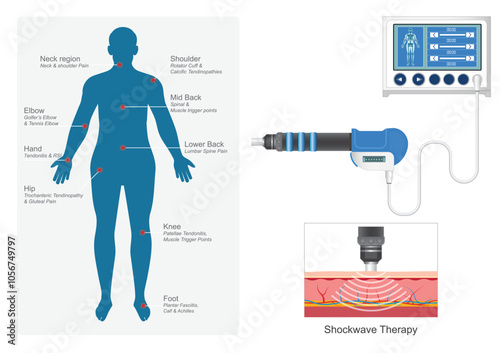 Extracorporeal Shock Wave Therapy treatment.