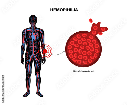 Hemophilia medical poster