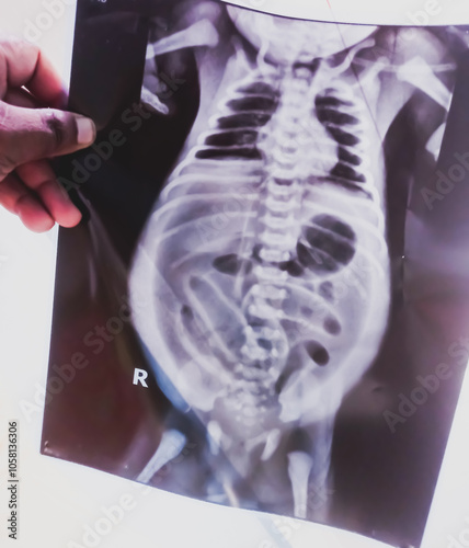 Pneumoperitoneum free air in abdomen xray.Hand holding a X-ray of abdomen AP view. Pneumatosis in the peritoneal cavity, a potential space within the abdominal cavity. photo