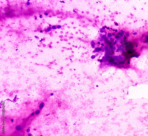 Obraz na plátně Photomicrograph of Osteolytic lesion of left proximal radium, Positive for malignant cell, small blue round cell tumor, ewing's sarcoma, PNET, metastatic carcinoma