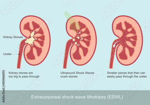 Extracorporeal shock wave lithotripsy (ESWL).