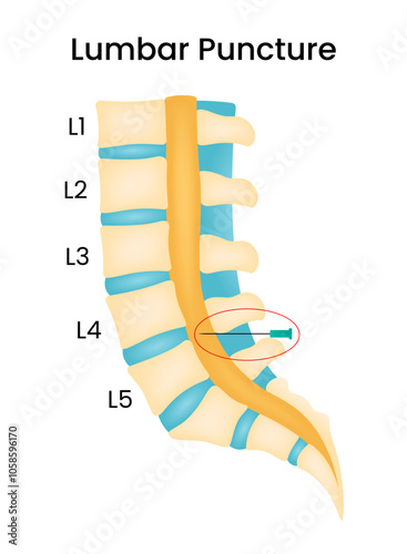 Overview of Lumbar Puncture Illustration