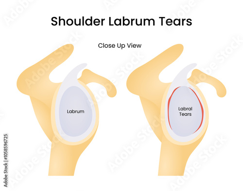 Shoulder Labrum Tears Close Up View