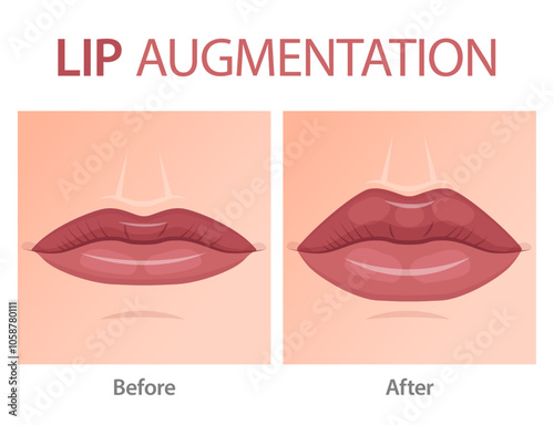 Lip Augmentation diagram on white background. 