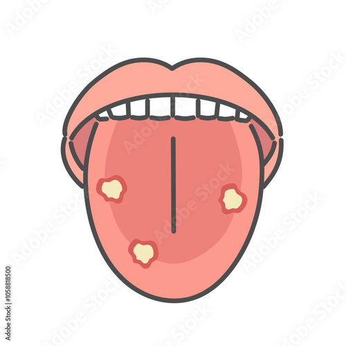 舌にできた口内炎　イラスト