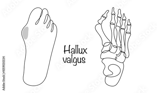 Hallux valgus