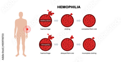 Hemophilia medical poster