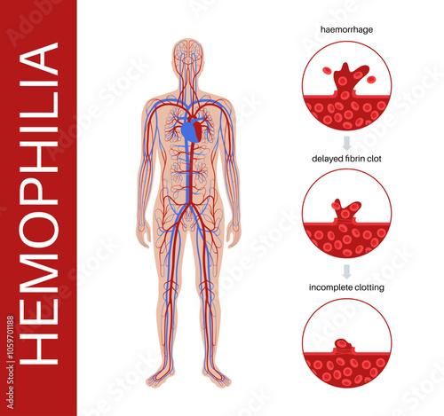 Hemophilia medical poster
