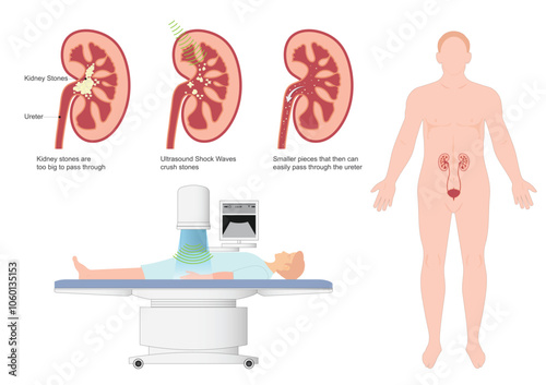 Extracorporeal Shock Wave Lithotripsy (ESWL) is the use.