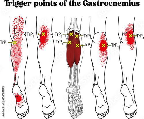 Trigger points  diagram, Trigger points of the Gastrocnemius