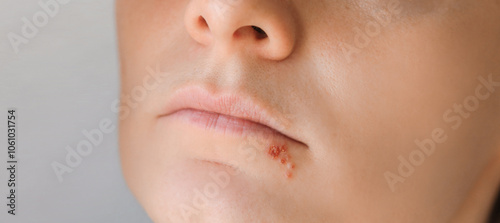 Close up of girl lips affected by herpes. Treatment of herpes infection and virus. Part of young woman face with finger touching pain on lips with herpes affected. Beauty dermatology concept