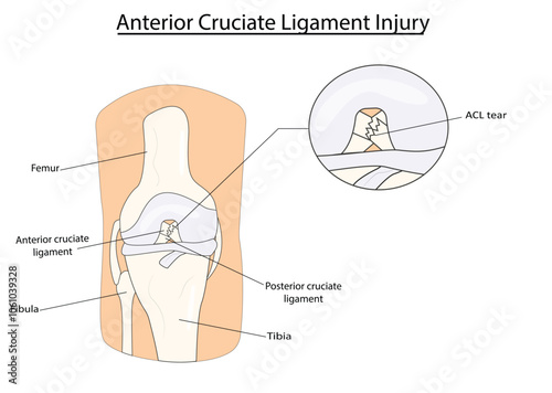 Anterior cruciate ligament(ACL) injury vector illustration