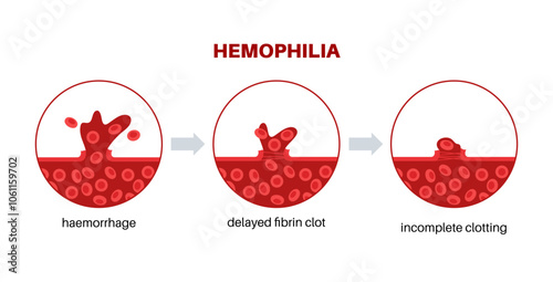 Hemophilia medical poster