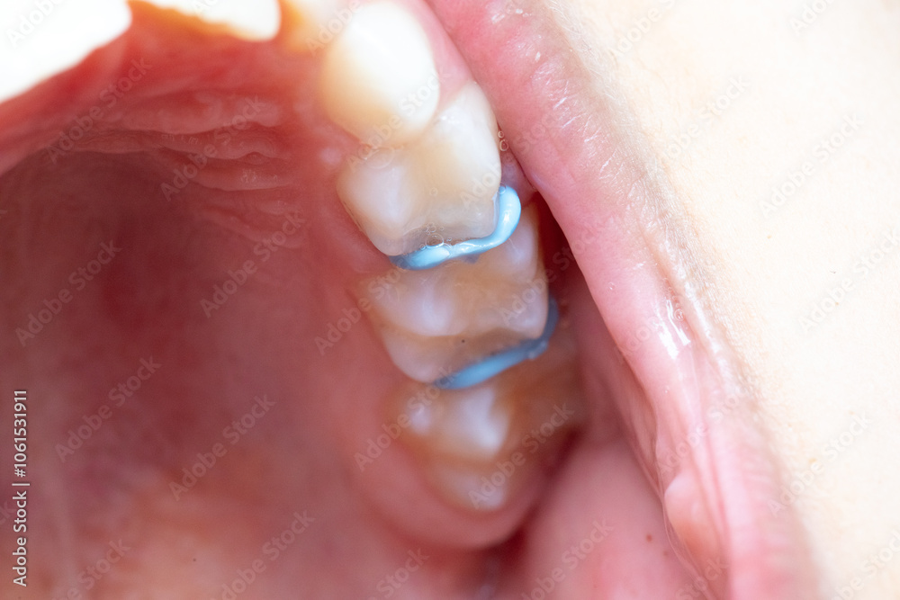 Fototapeta premium Dental sealant preventing bacterial growth in hard-to-reach areas
