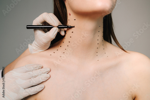 Tableau sur toile Cosmetologist is drawing dotes before botulinum toxin injection in platysma of a woman