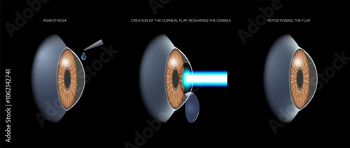 LASIK eye surgery