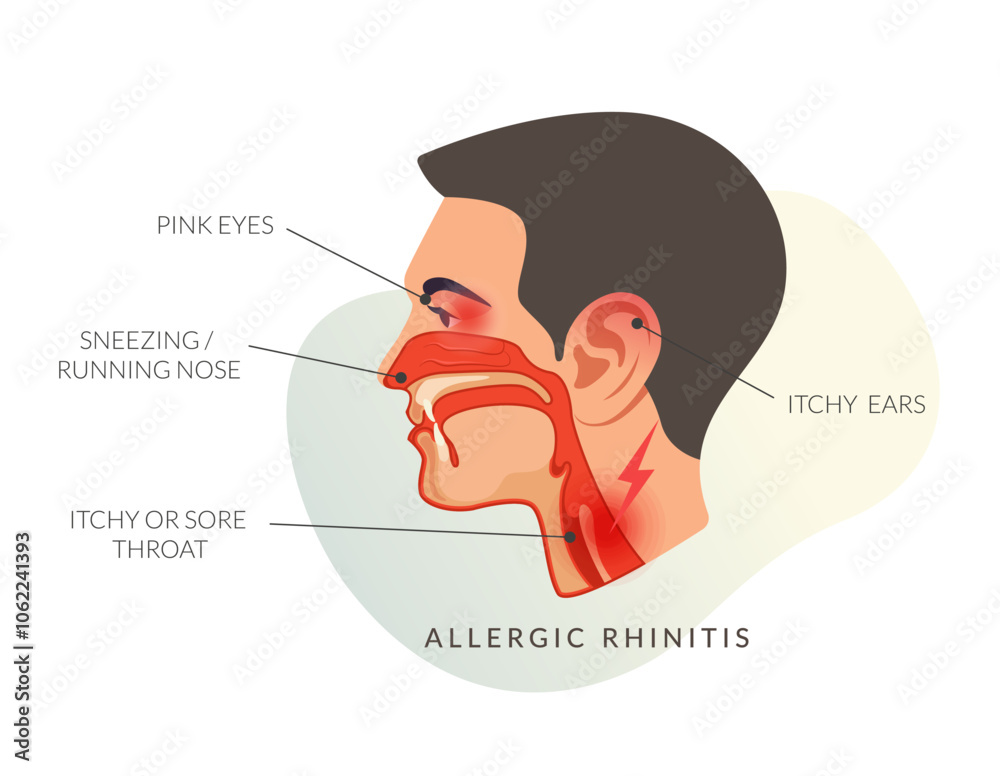 Obraz premium Allergic rhinitis Symptoms - Sneezing - Running Nose - Stock Illustration
