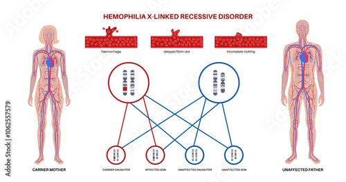 Hemophilia inheritance poster