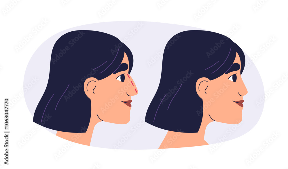 Fototapeta premium Rhinoplasty, plastic surgery before and after. Woman patient profile, nose reshaping and cosmetic aesthetic enhancement, modification, correction. Flat vector illustration isolated on white background