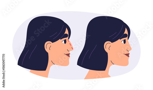 Rhinoplasty, plastic surgery before and after. Woman patient profile, nose reshaping and cosmetic aesthetic enhancement, modification, correction. Flat vector illustration isolated on white background