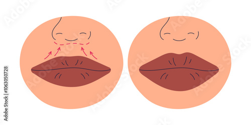 Lip augmentation procedure, plastic surgery. Before and after cosmetic shaping with filler for big volume. Aesthetic reshaping, correction. Flat vector illustration isolated on white background
