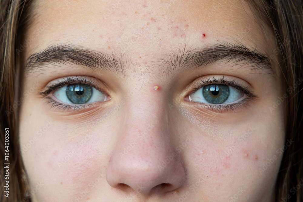 Fototapeta premium Close-up of teenage girl with acne on forehead and nose. A close-up portrait of a teenage girl with light blue eyes and a natural skin complexion, showing acne on her forehead and nose.