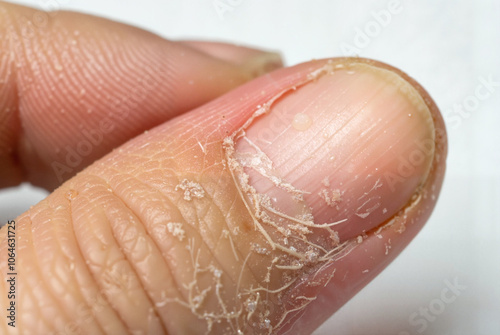 Close-up of dry cracked skin on thumb

