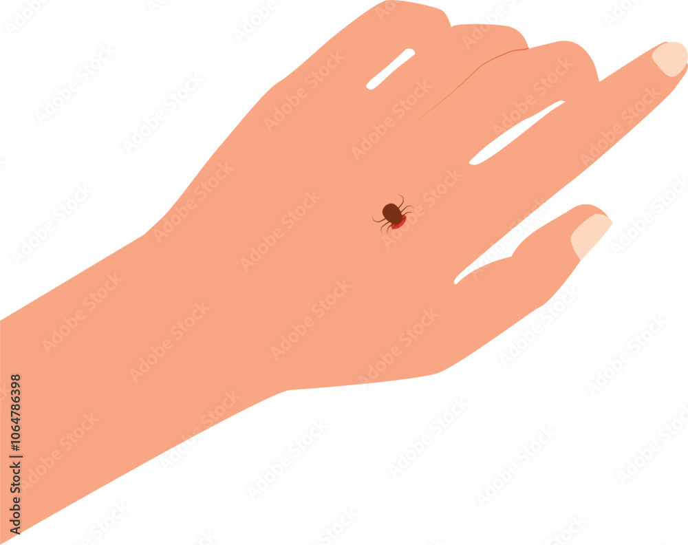 Tick bite. Tick on a human's hand. Healthcare illustration. Vector illustration. Tick bite. Tick on a human's hand. Healthcare illustration. Vector illustration.