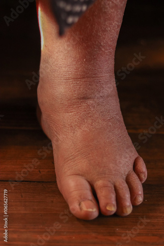 old seniors with swollen feet ,elderly people.edema or swelling in the feet.kidney or liver disease,Dry skin.Feet of a senior woman between 70 and 80 years old.Close-up .health problems concept