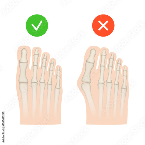 Hallux valgus. Valgus deformity of the big toe joint. Vector illustration.