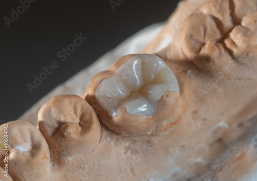 Dental Restoration with Ceromer: Quality and Natural Aesthetics,onlay
